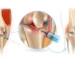 FlexaOne Injection for Osteoarthritis
