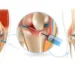FlexaOne Injection for Osteoarthritis
