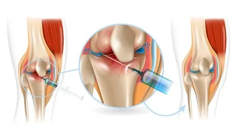 FlexaOne Injection for Osteoarthritis